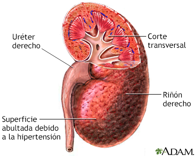 Riñón hipertensivo