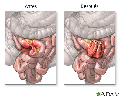 Antes y después de anastomosis del intestino delgado