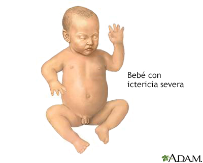 Ictericia infantil