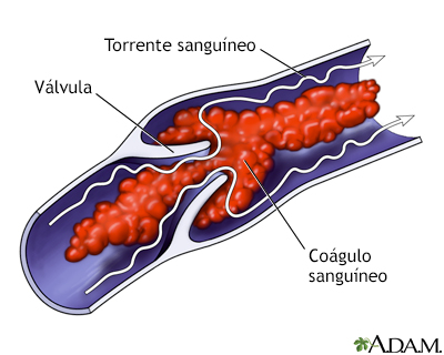 Coágulo de sangre venoso