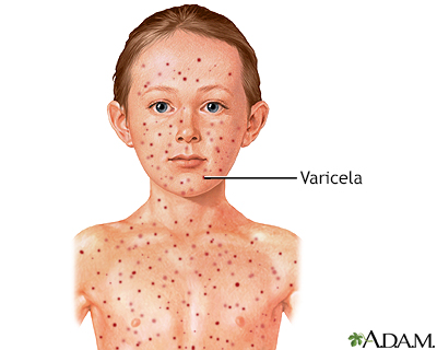 Varicela