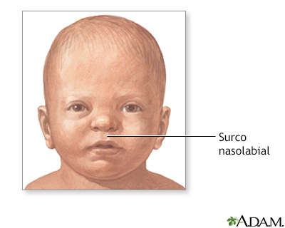 Surco nasolabial