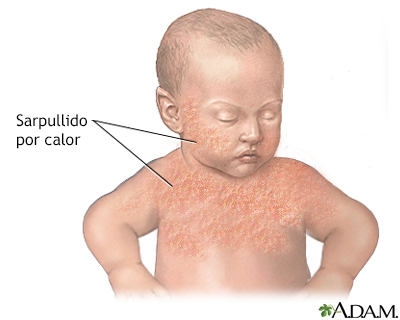 Erupción por calor del bebé