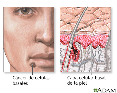 Cáncer de células basales