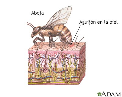 Picadura de abeja