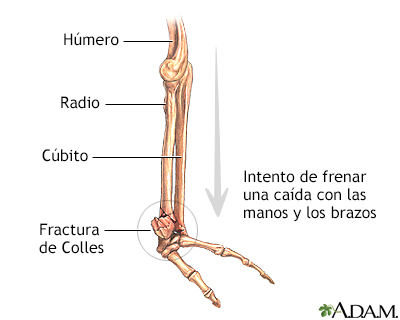 Fractura de Colles