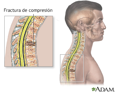 Fractura por compresión