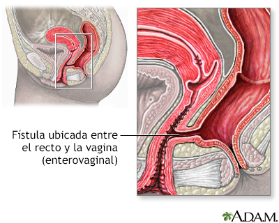 Fístula