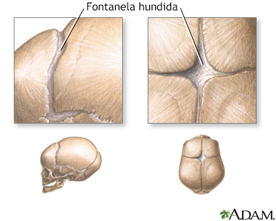 Fontanelas hundidas (vista superior)