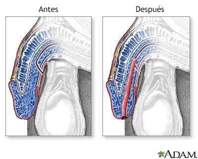 Hipospadias