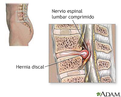 Disco lumbar herniado