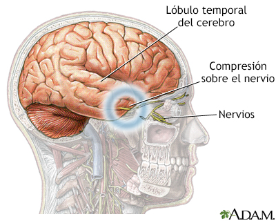 Hernia cerebral