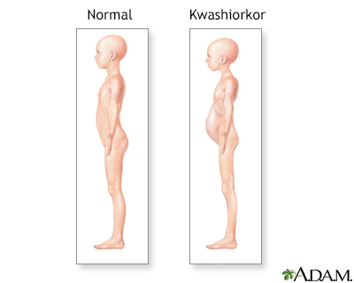 Síntomas de Kwashiorkor