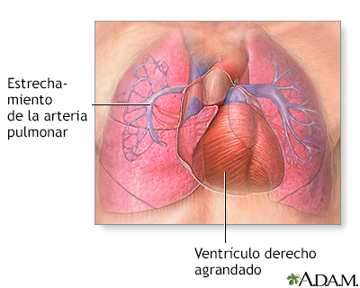 Hipertensión pulmonar primaria