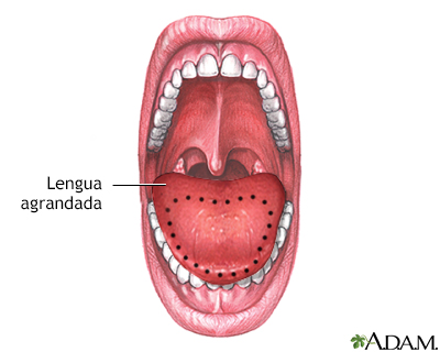 Macroglosia