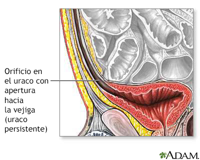 Uraco permeable