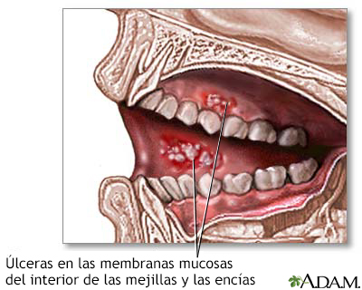 Úlceras de la boca