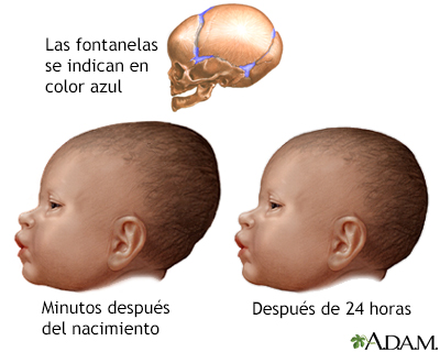 Amoldamiento de cabeza del recién nacido