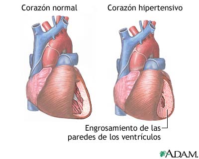 Hipertensión