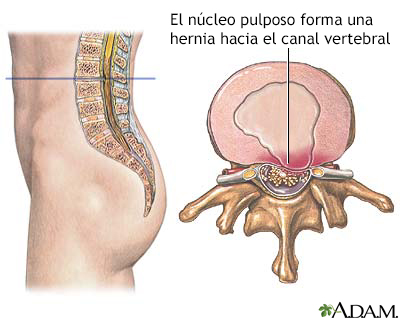 Núcleo pulposo herniado