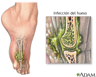 Osteomielitis