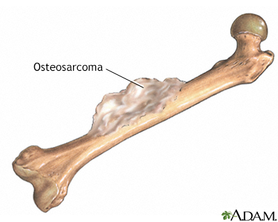 Tumor de hueso