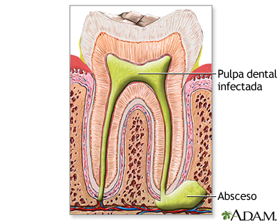 Absceso dental