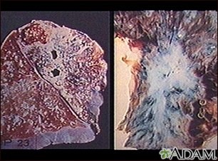 Tuberculose no pulmão