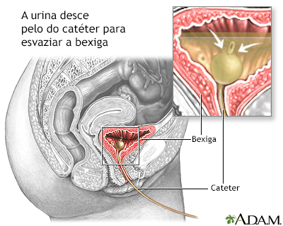 Cateterização da bexiga, mulheres