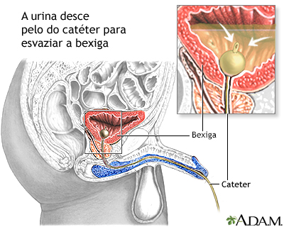 Cateterismo urinário, masculino