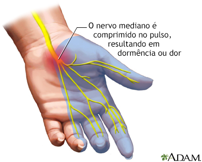 Síndrome do túnel do carpo