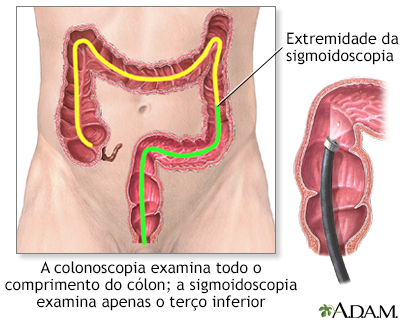 Colonoscopia