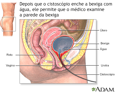 Cistoscopia