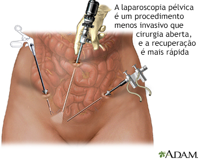 Laparoscopia pélvica