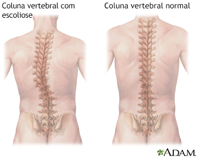 Escoliose