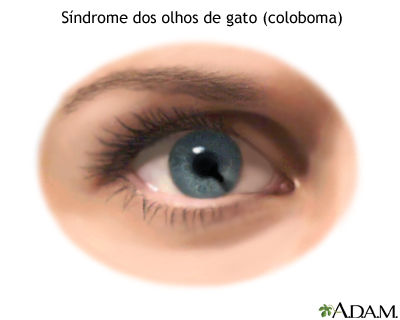 Síndrome dos olhos de gato