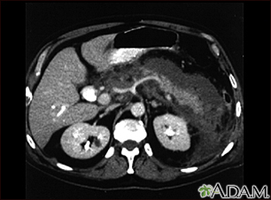 Pancreatite, aguda - tomografia computadorizada