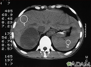 Tumor Adrenal - Tomografia Computadorizada