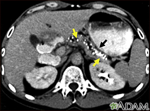 Pancreatite, crônica - Tomografia computadorizada