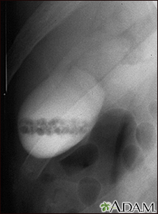 Cálculos biliares, colangiografia