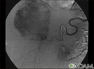 Hemangioma - angiograma