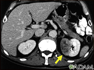 Tumor nos rins - tomografia computadorizada