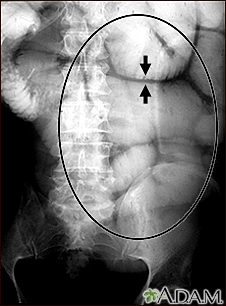 Íleo - raio X de distensão intestinal