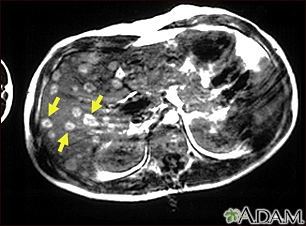 Melanoma do fígado -  Imagem por ressonância magnética