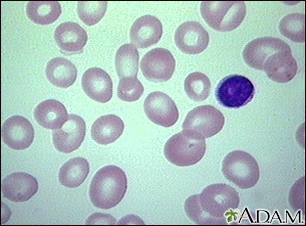 Anemia megaloblástica - visualização de glóbulos vermelhos