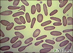 Glóbulos vermelhos, eliptocitose