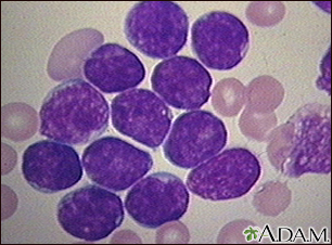 Leucemia linfocítica aguda - fotomicrografia