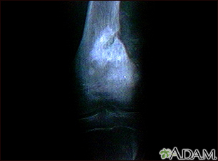 Sarcoma osteogênico - raio X