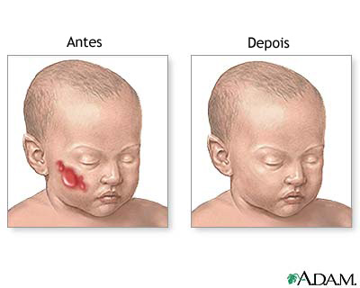 Cuidado após o procedimento