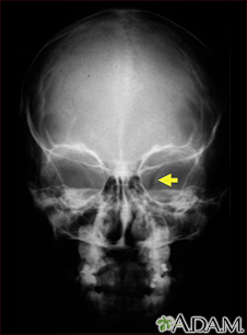 Neurofibromatose I, forame óptico aumentado